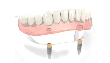 Perfect Smile LOCATOR® Abutment retained Overdenture